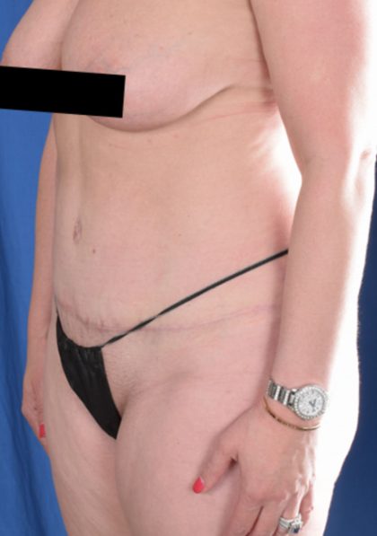Tummy Tuck Before & After Patient #1725