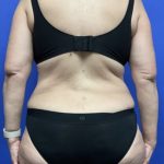 Liposuction Before & After Patient #1746