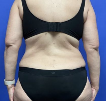 Liposuction Before & After Patient #1746