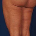 Liposuction Before & After Patient #1757