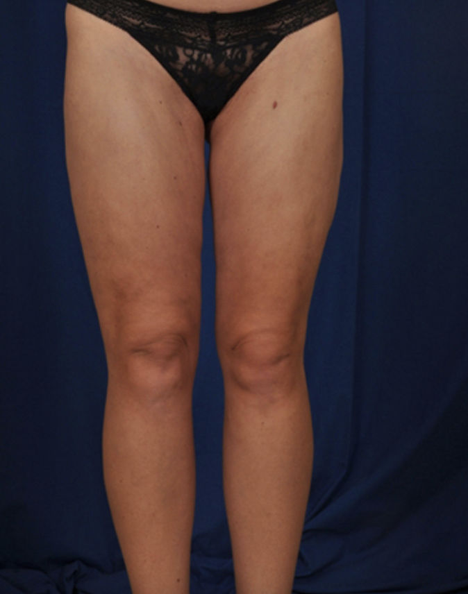 Liposuction Before & After Patient #1788