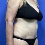 Tummy Tuck Before & After Patient #1698