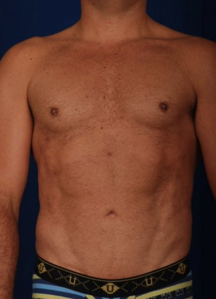 Liposuction Before & After Patient #1765