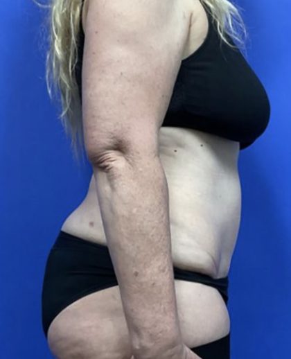 Tummy Tuck Before & After Patient #1698