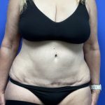 Tummy Tuck Before & After Patient #1698