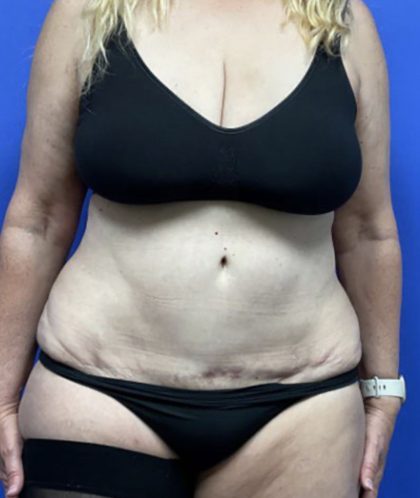 Bexley woman has a tummy tuck after losing 8 stone