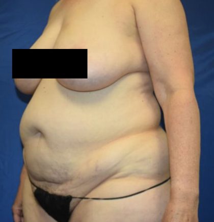 Tummy Tuck Before & After Patient #1698