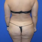 Fat Transfer to Buttocks Before & After Patient #1689