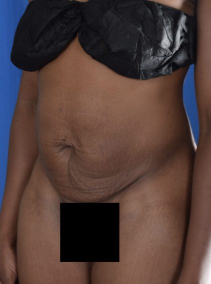 Tummy Tuck Before & After Patient #1726