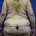 Liposuction Before & After Patient #1746