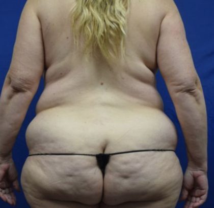 Liposuction Before & After Patient #1746