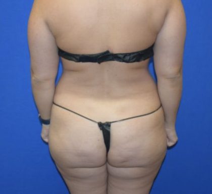 Fat Transfer to Buttocks Before & After Patient #1689