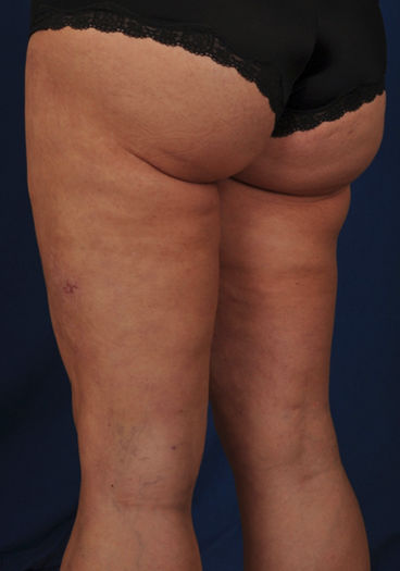 Liposuction Before & After Patient #1757