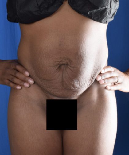 Tummy Tuck Before & After Patient #1726