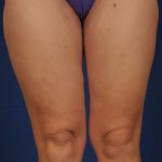 Liposuction Before & After Patient #1788