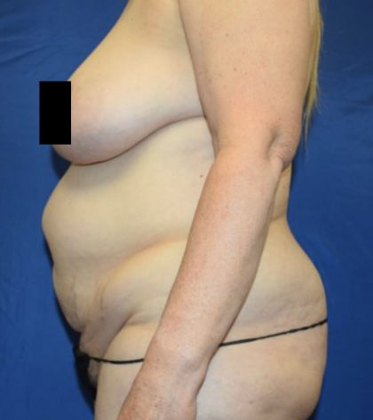 Tummy Tuck Before & After Patient #1698