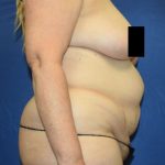 Tummy Tuck Before & After Patient #1698