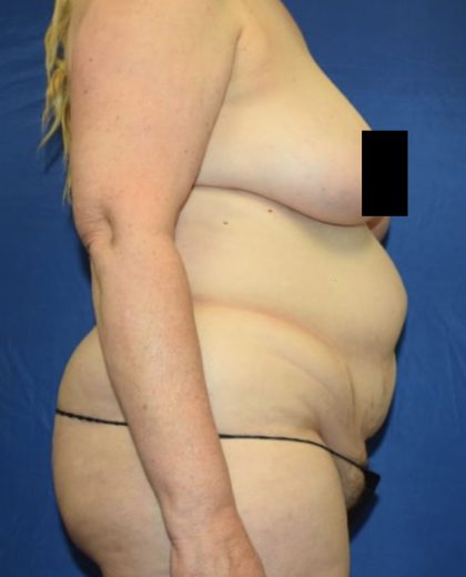 Tummy Tuck Before & After Patient #1698