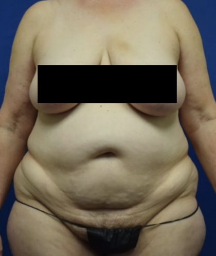 Tummy Tuck Before & After Patient #1698