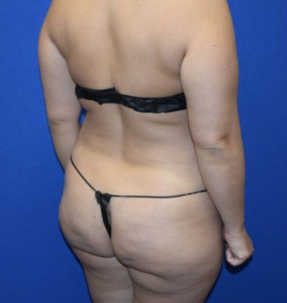 Fat Transfer to Buttocks Before & After Patient #1689
