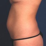 Liposuction Before & After Patient #1751