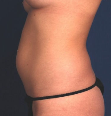 Liposuction Before & After Patient #1751